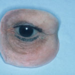 athens ocular prostheseis 1