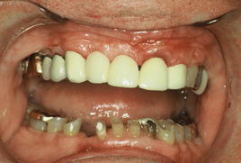 full mouth rehabilitation 3 before