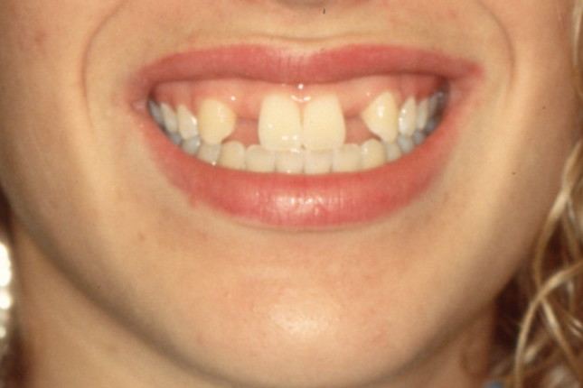 The Maryland bridge is a method used to replace a missing tooth