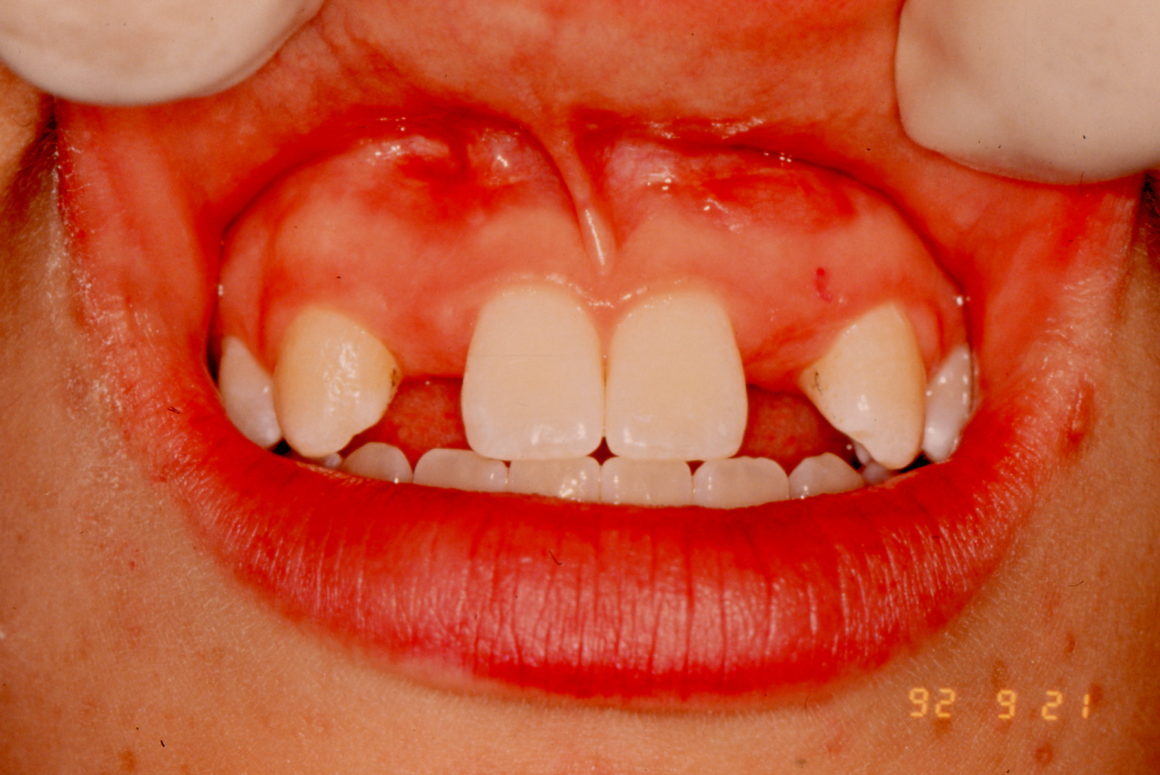 The Maryland bridge is a method used to replace a missing tooth