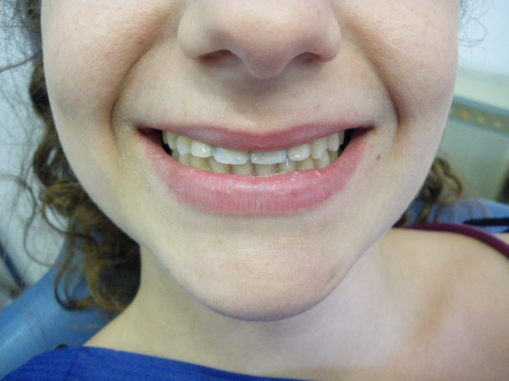 The Maryland bridge is a method used to replace a missing tooth