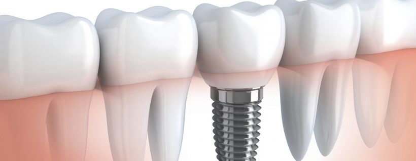 Under what conditions may dental implants be the best solution?