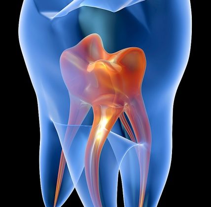 Υπερευαισθησία δοντιών: Πώς προκαλείται και πώς αντιμετωπίζεται;