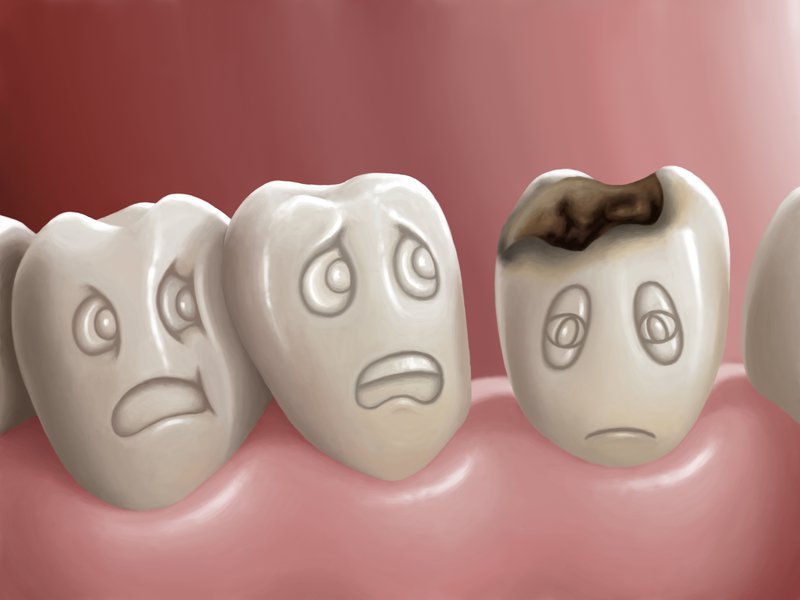 Πώς προλαμβάνεται η τερηδόνα και επανασβεστιώνεται η οδοντική επιφάνεια ;