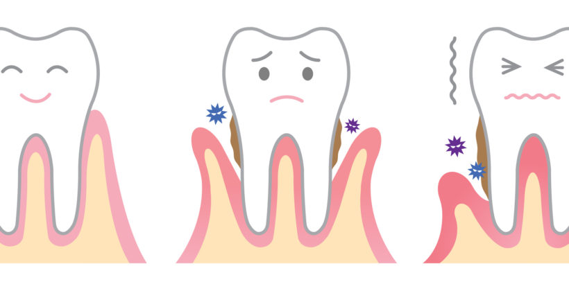 Can gum disease be serious for my health ?