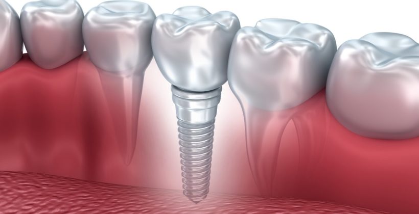 Πώς μπορούμε να έχουμε επιτυχή οδοντικά εμφυτεύματα στο στόμα μας;